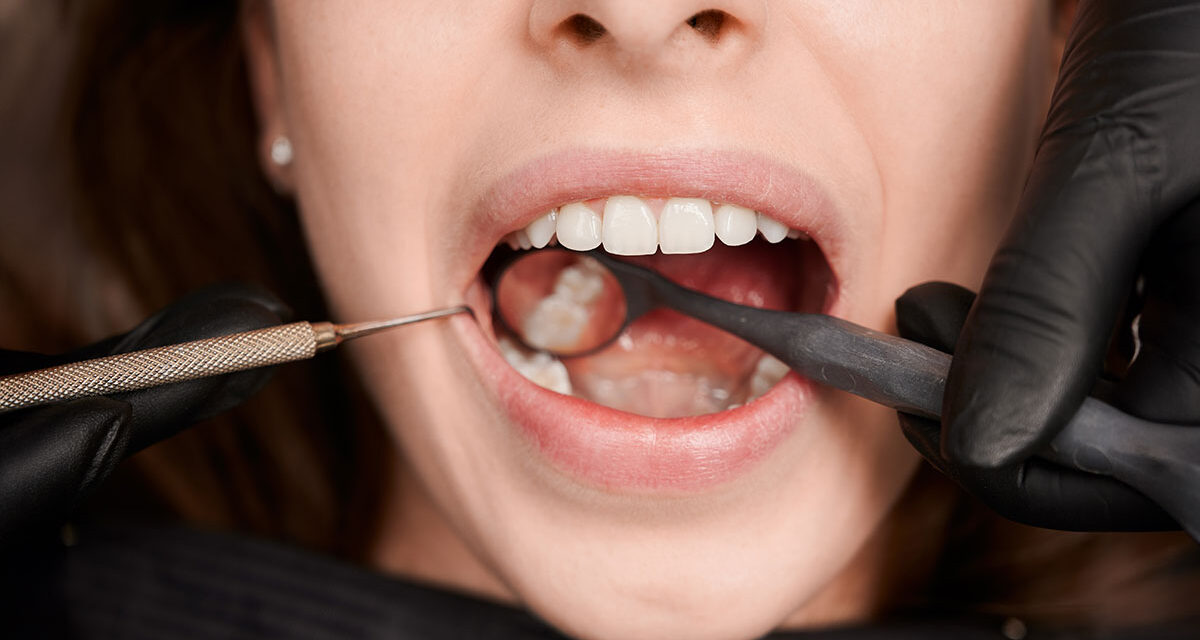 Natural and Aesthetic Smiles with Onlay Ceramic Restorations | Ova Dental Clinic, Kartal